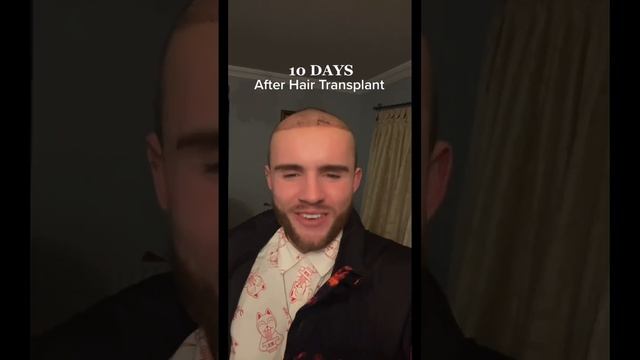 Hair Transplant Results !