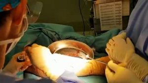 Нанесение костного цемента Neocement для замещения дефектов и регенерации костной ткани.