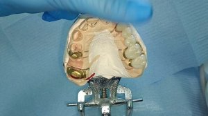 протезирование