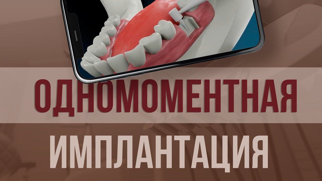 ОДНОМОМЕНТНАЯ ИМПЛАНТАЦИЯ ЗУБОВ: доступное РЕШЕНИЕ для 93% обратившихся пациентов.
