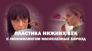 Пластика нижних век с липофилингом носослезных борозд