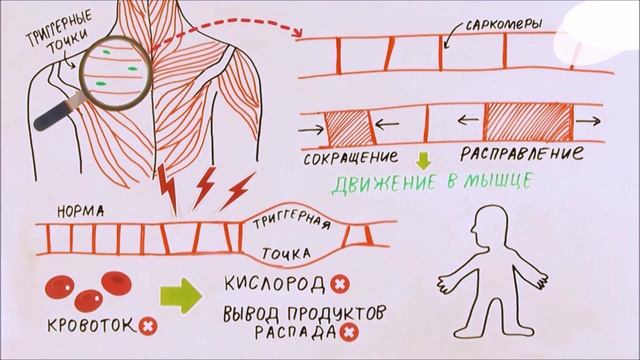 Почему болят мышцы?