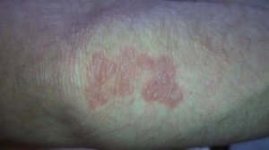 Псориаз на локтях после обработки дерматологическим кремом Hudsalva