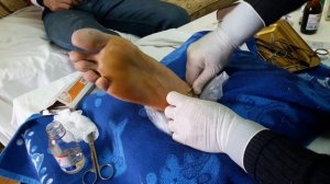 1.СТЕРЖНЕВАЯ МОЗОЛЬ.ОБРАБОТКА И УДАЛЕНИЕ СТЕРЖНЕВОЙ МОЗОЛИ.ДОКТОР ФИЗУЛИ АЛИЕВ.19.11.2018