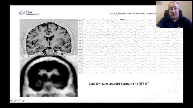 Лекция№8. «Основы эпилептологии. Хирургическое лечение»
