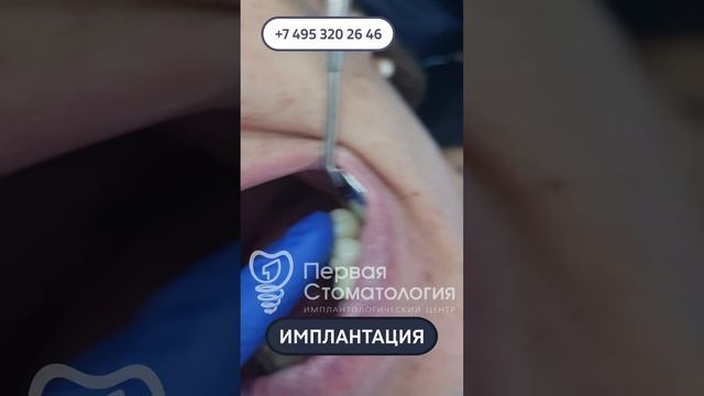 Имплантация зубов пациенту. Абатмент.