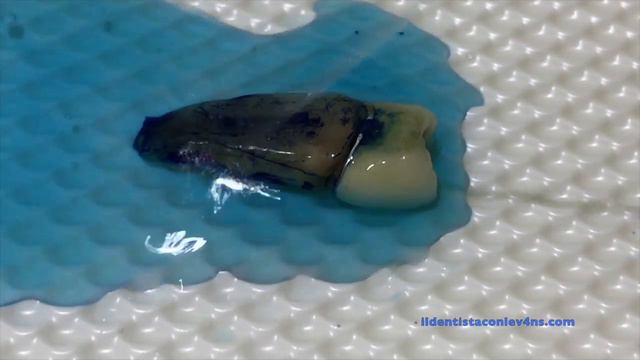 How to find a dental fracture смотреть онлайн