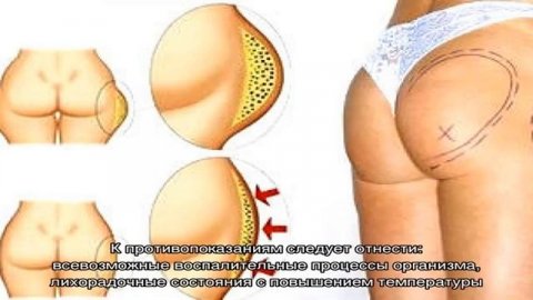 Липопластика – создание красоты руками