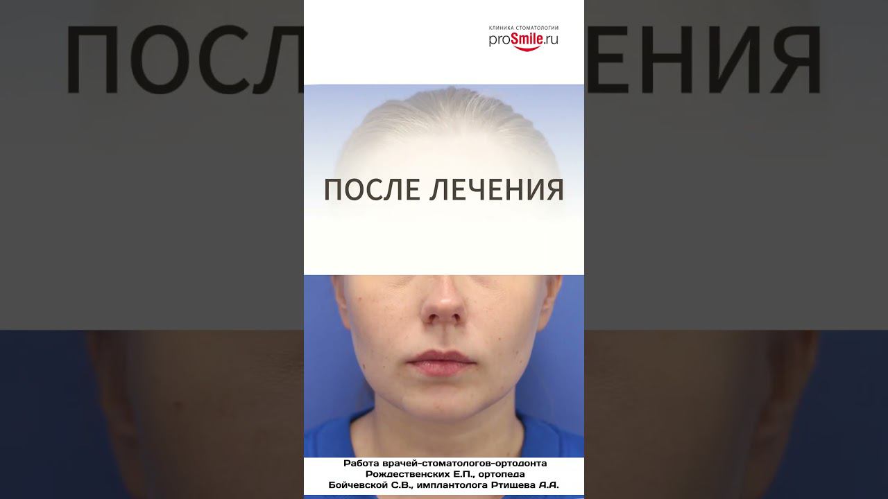Преображение улыбки. Работа врачей: Рождественских Е.П., Бойчевской С.В., Ртищева А.А.
