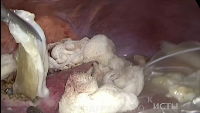 Лапароскопическая эхинококкэктомия из печени (Laparoscopic echinococcus treatment) смотреть онлайн
