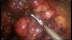 Лапароскопическая урология и онкоурология