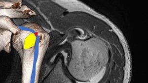 Subscapularis Tendon Tears on MRI