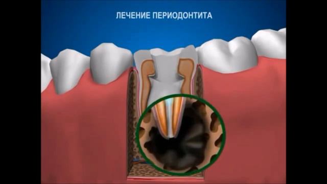 Лечение периодонтита  Терапевтическая стоматология