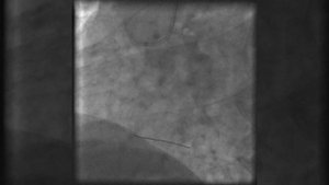 Стентирование сосудов сердца