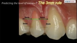 3mm RULE in 3 minutes