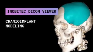 Сложный случай моделирования краниоимплантата в Inobitec DICOM Viewer Pro
