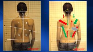 2.13. Массаж при нарушениях осанки и сколиозах | Медицинский массаж. Цикл 2