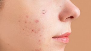 How To Remove Acne In Adobe Photoshop CC 2023