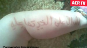 Арабча ёзув бу болани танасида - Аллохни мужизаси