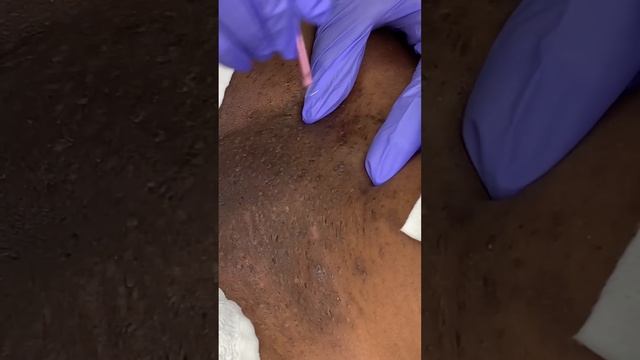 Brazilian Extractions (2nd video) смотреть онлайн