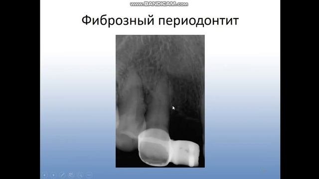 Лучевая диагностика периодонтита и остеомиелита