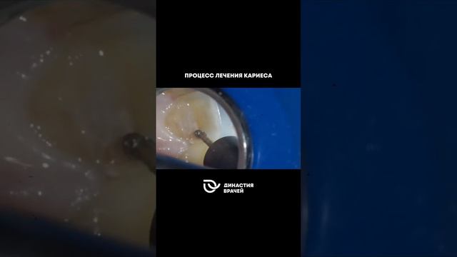 Лечение кариеса без боли в клинике “Династия врачей” 🦷