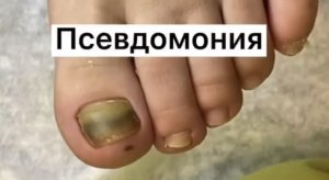Псевдомония