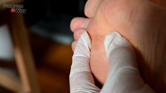 ВСЕГО ОДНА ТЮБИК и ПАПИЛЛОМ НЕТ!100 Средство от Кондилом и Бородавок! смотреть онлайн