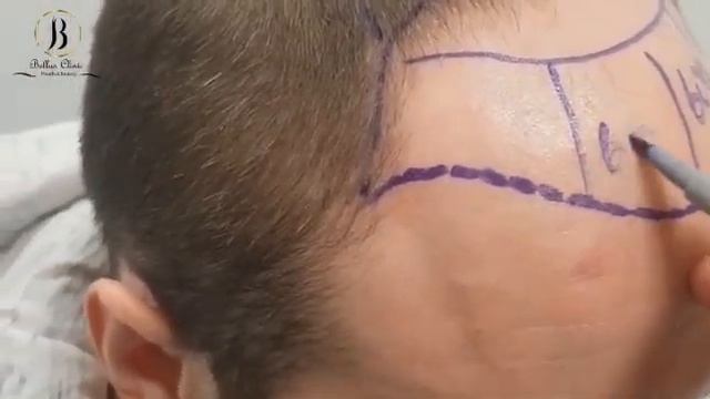 Отзыв о пересадке волос  Bellus Clinic. Результат пересадки волос Матвея из России