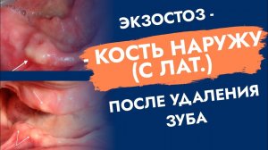 Экзостоз. Торчит кость после удаления.