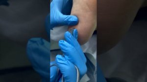 Удаление осколка из стопы пациентки
