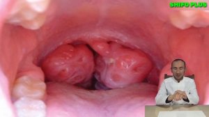 ANGINA KASALLIGINI DAVOLASH UCHUN RETSEPT VA TAVSIYALAR Ангинани даволаш учун рецепт ва тавсиялар