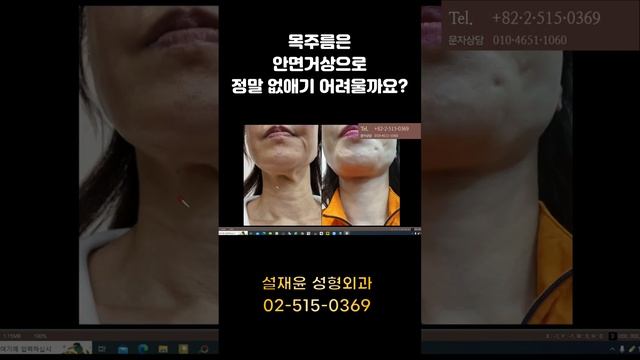 목주름 안면거상 수술로 정말 없애기 어려울까요? смотреть онлайн