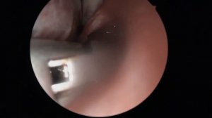 Эндоскопическая септопластика( кристотомия).Врач Антипова Ю.А.