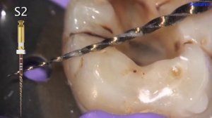 Самая популярная в мире эндодонтическая система никель-титановых инструментов ProTaper Universal