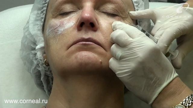 Микроармирование переорбитальной области смотреть онлайн