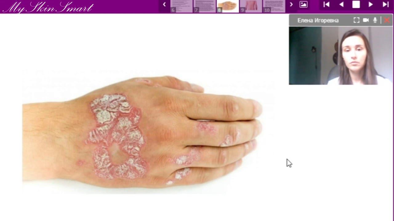 Лекция 12. Псориаз. Розовый лишай Жибера. Чесотка смотреть онлайн