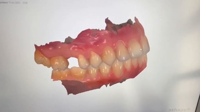 Внутриротовой сканер 3Shape