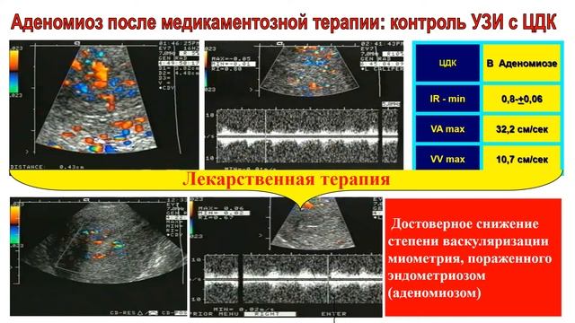 Эндометриоз Аденомиоз 2017 смотреть онлайн