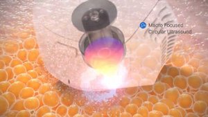 Ультразвуковая липосакция на аппарате Ulfit