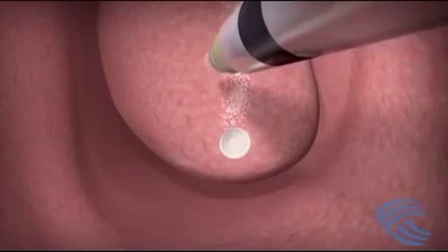 Лечение вазомотора плазмой 3D.mp4 смотреть онлайн