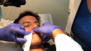 LIP SEBACEOUS CYST REMOVAL - Dr. Carlos A. Pardo