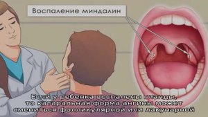 Покраснение гланд и воспаление миндалин у ребенка