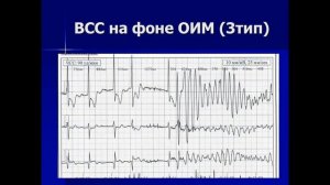 31 03 22 Куприянова АВ Диагностика раних осложнений инфаркта миокарда