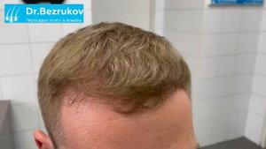 Пересадка волос в Алматы. Клиника Dr.Bezrukova.