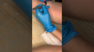 Электроэпиляция голени