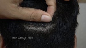 Зудящая сухая кожа головы Большие царапины от перхоти #874