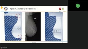 Основные ошибки в укладках при проведении маммографии
