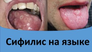 Сифилис на языке.