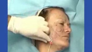 Лазерная липосакция.flv